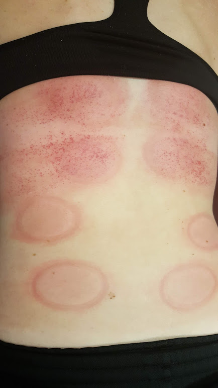 Hystamine Reaction to cupping