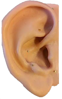 Placement of the needles in the lobe